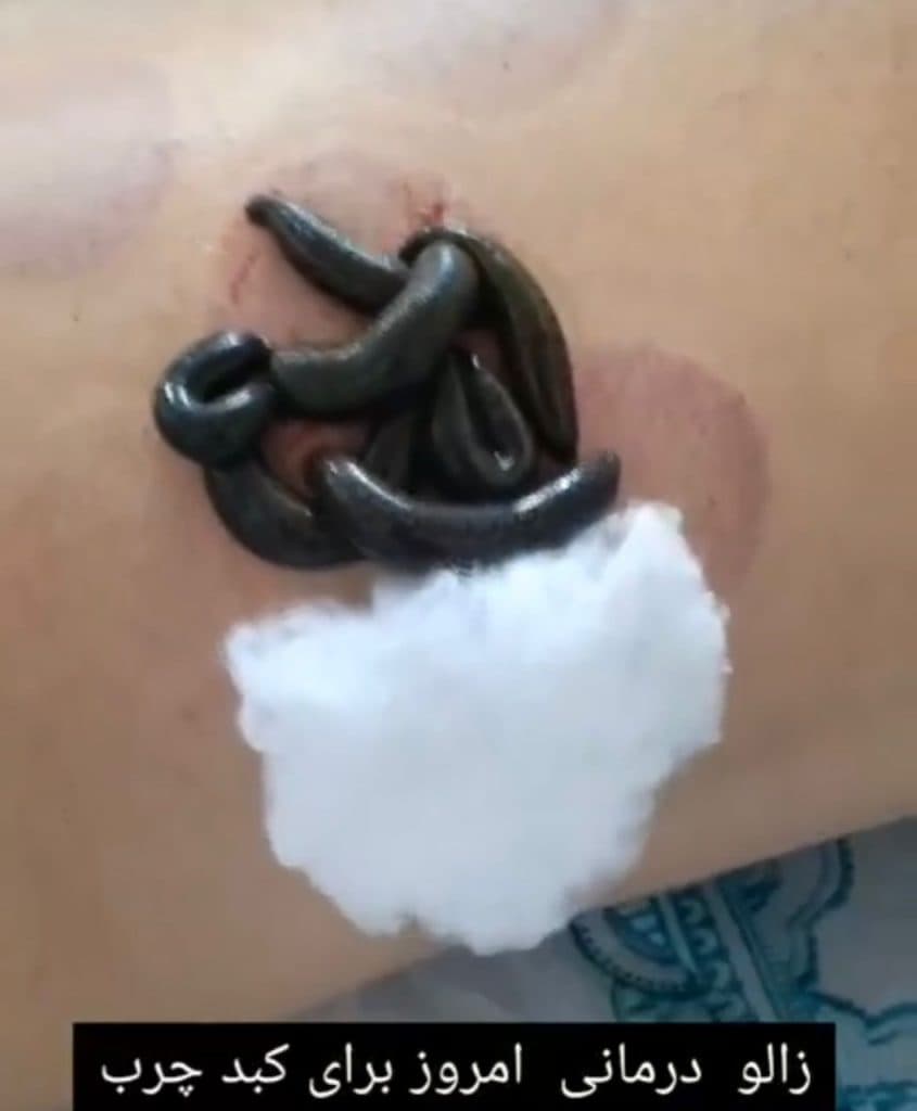 مهسا حلاجی حکیم طب سنتی و حجامت بادکش گرم در یزد