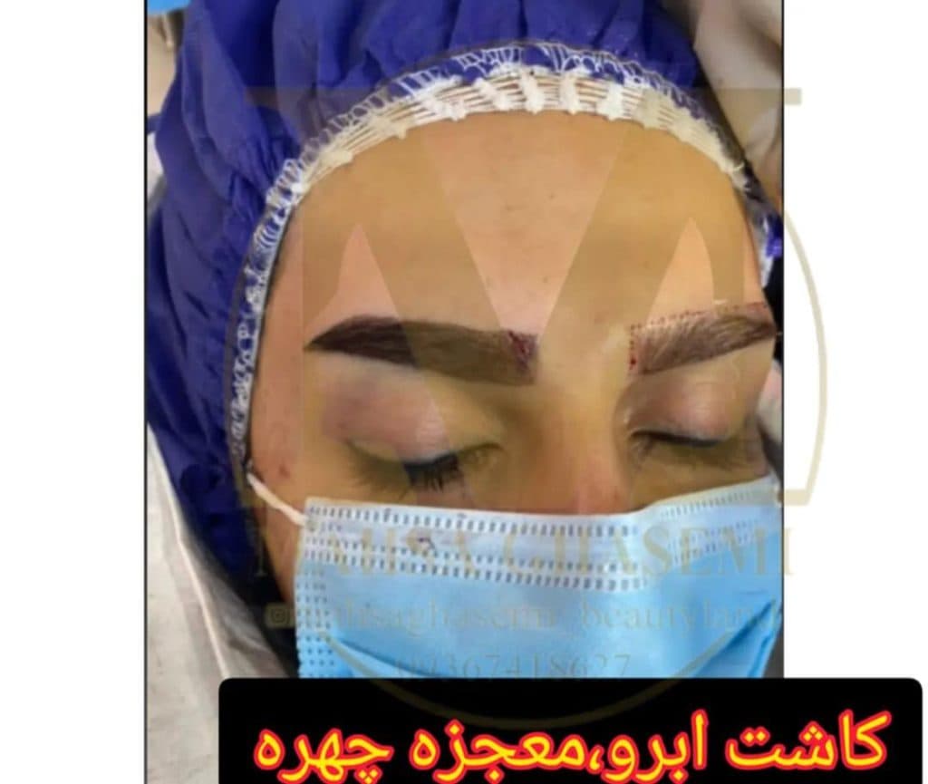 خدمات کاشت مو مهسا قاسمی در شیراز