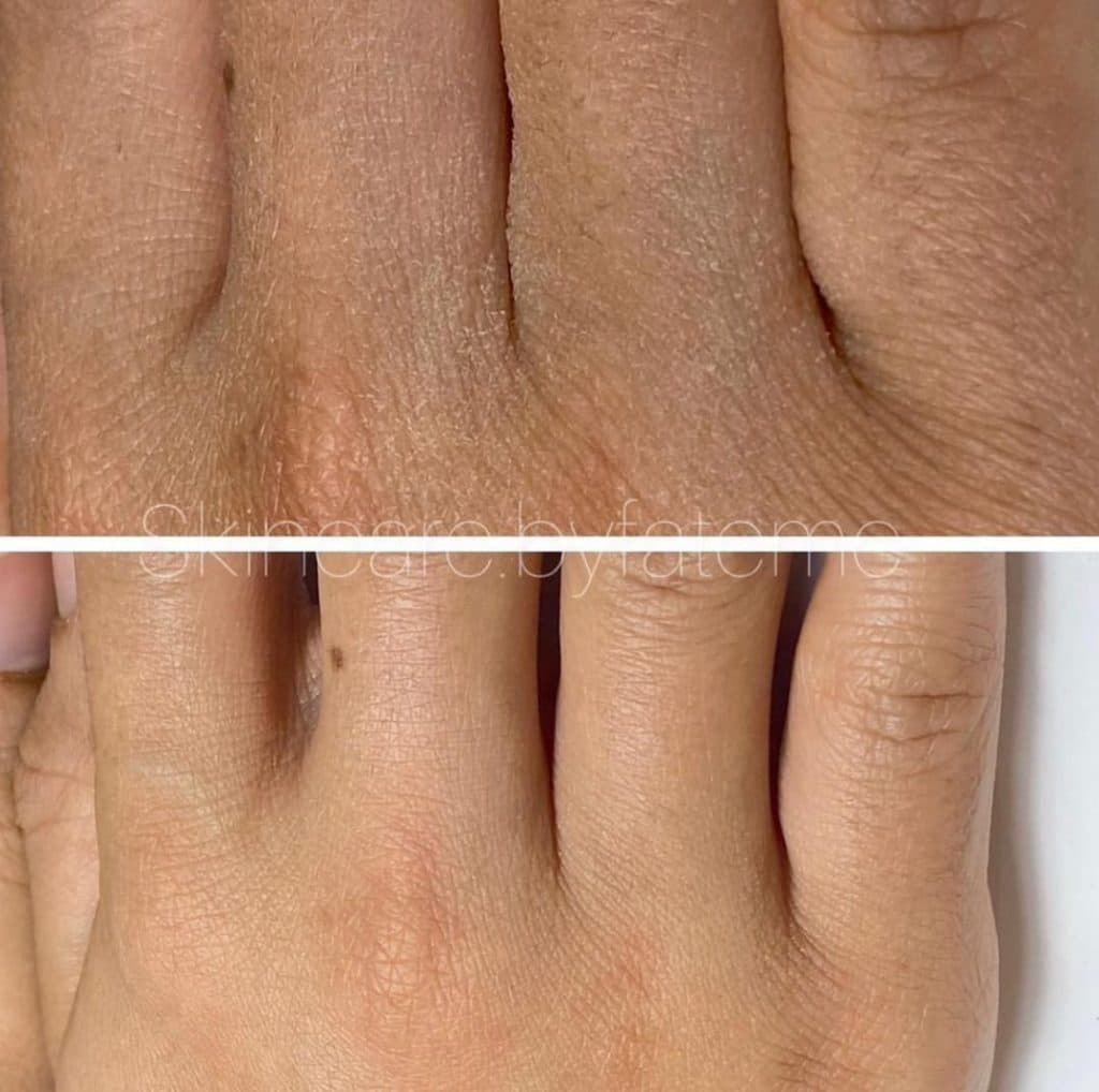 آموزش و خدمات تخصصی فیشیال با دستگاه پولاژن فرح اسدالله پور در رفسنجان