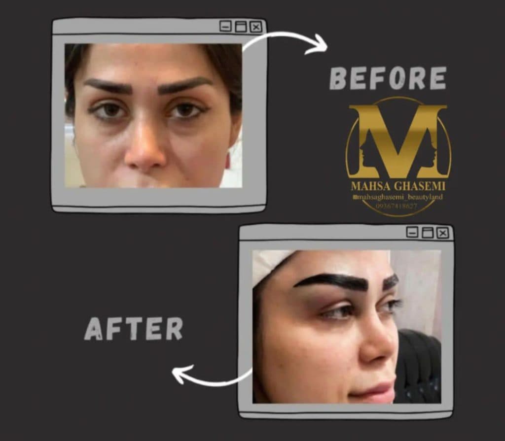 خدمات کاشت مو مهسا قاسمی در شیراز