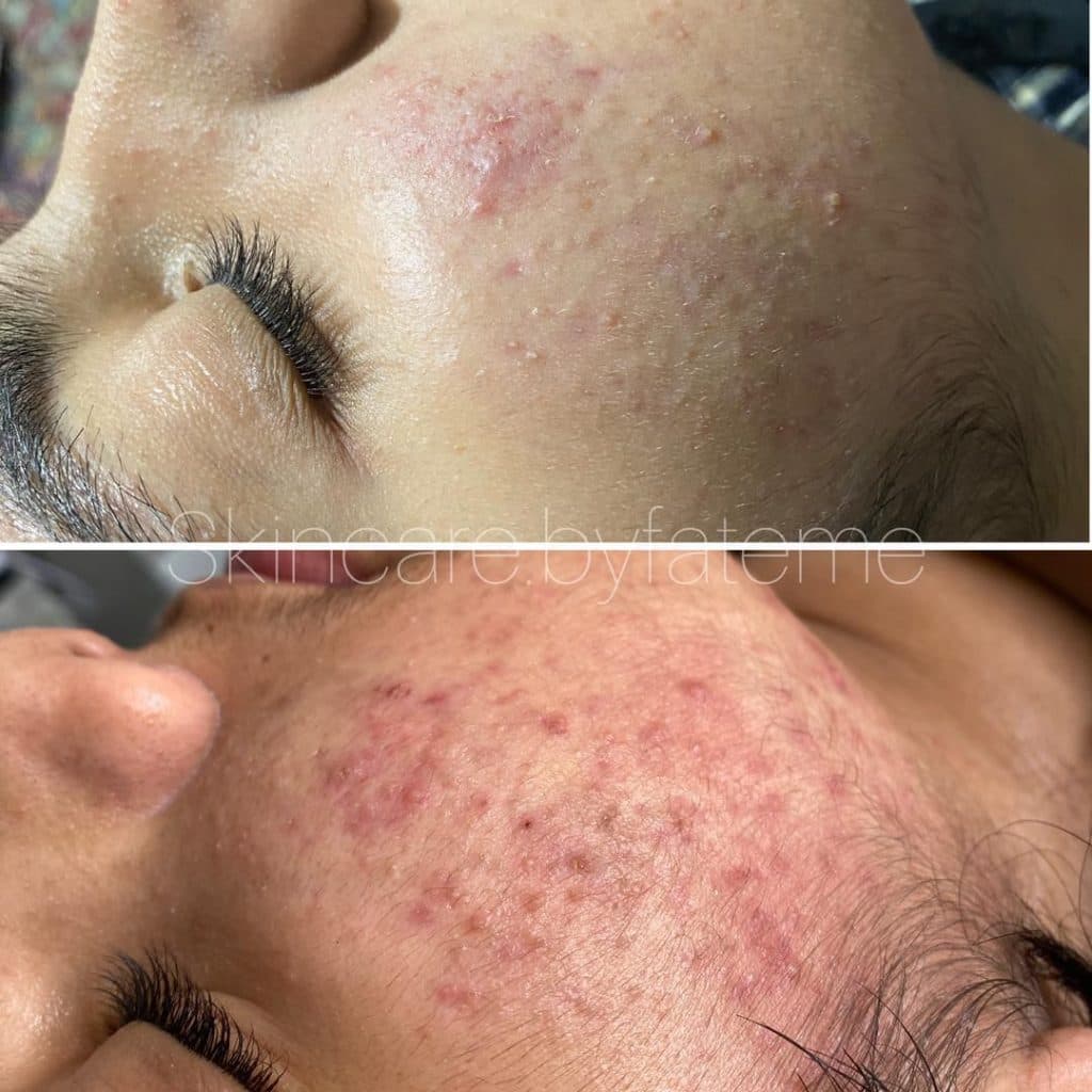 آموزش و خدمات تخصصی فیشیال با دستگاه پولاژن فرح اسدالله پور در رفسنجان