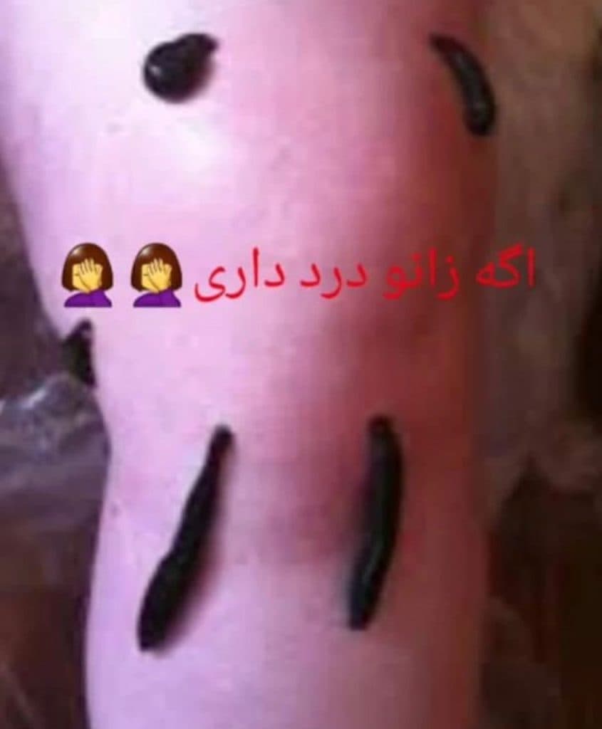 مهسا حلاجی حکیم طب سنتی و حجامت بادکش گرم در یزد