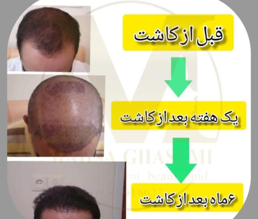 خدمات کاشت مو مهسا قاسمی در شیراز