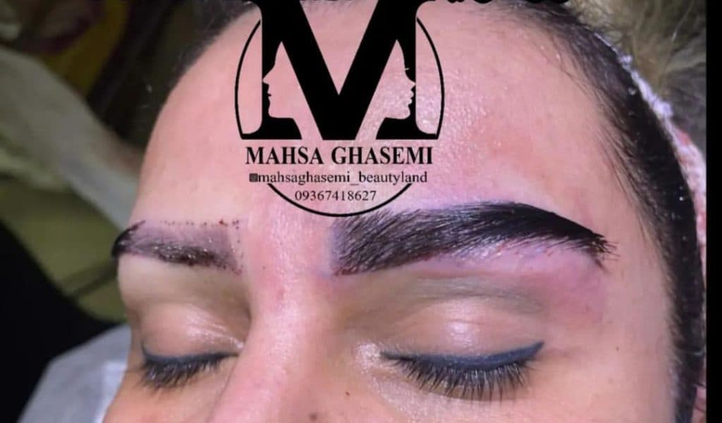 خدمات کاشت مو مهسا قاسمی در شیراز