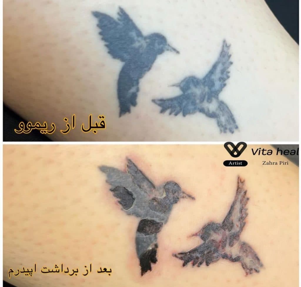 مرکز تخصصی میکروبلیدینگ ابرو و ریموو تتو آزاده پیری در شرق تهران