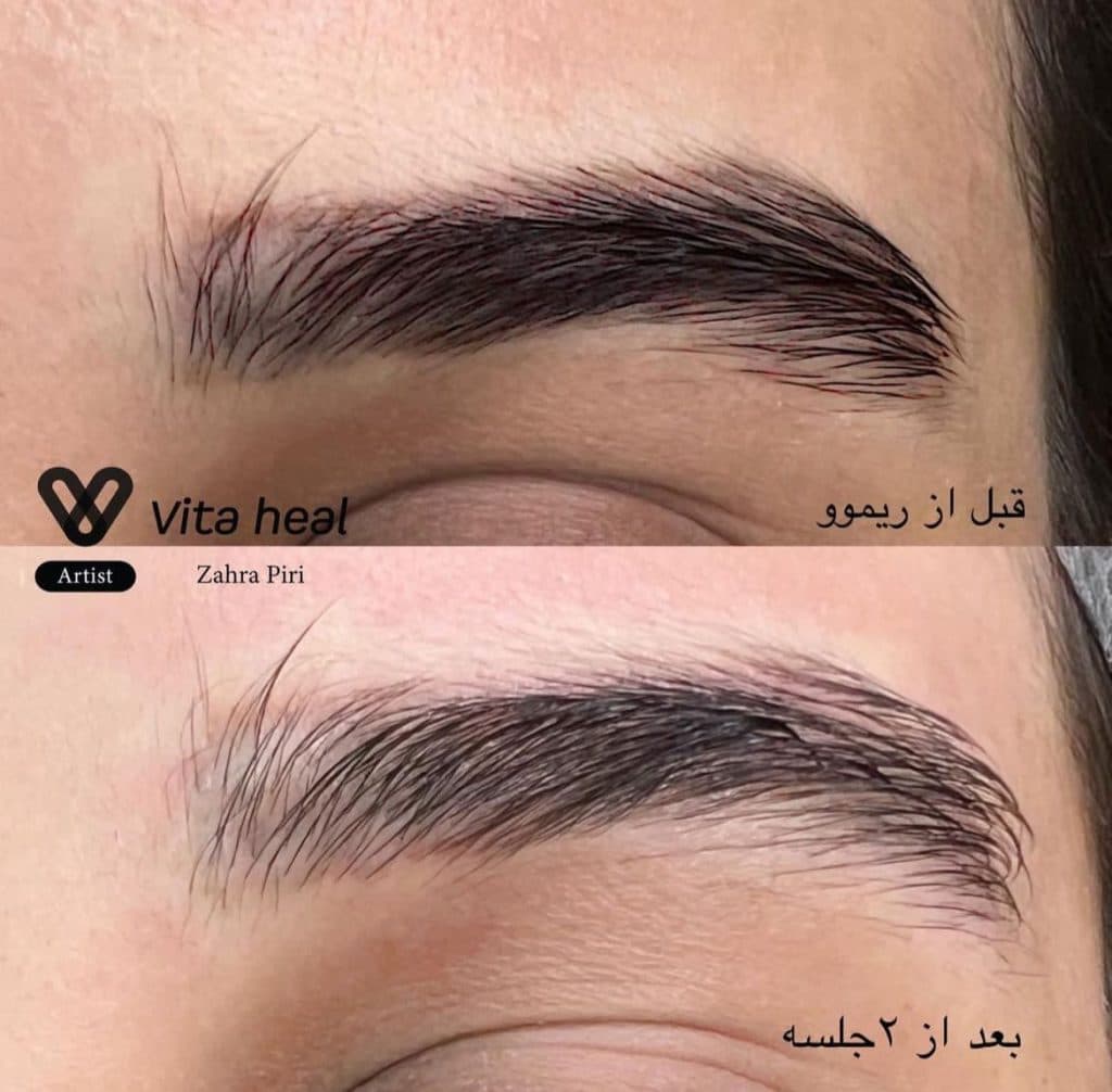 مرکز تخصصی میکروبلیدینگ ابرو و ریموو تتو آزاده پیری در شرق تهران