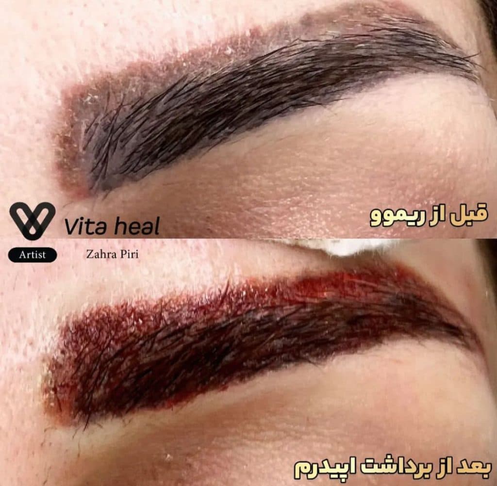 مرکز تخصصی میکروبلیدینگ ابرو و ریموو تتو آزاده پیری در شرق تهران