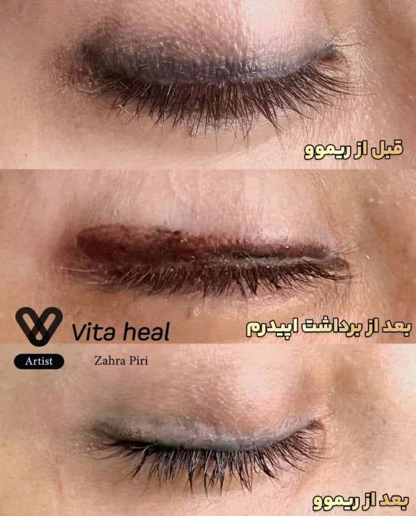 مرکز تخصصی میکروبلیدینگ ابرو و ریموو تتو آزاده پیری در شرق تهران