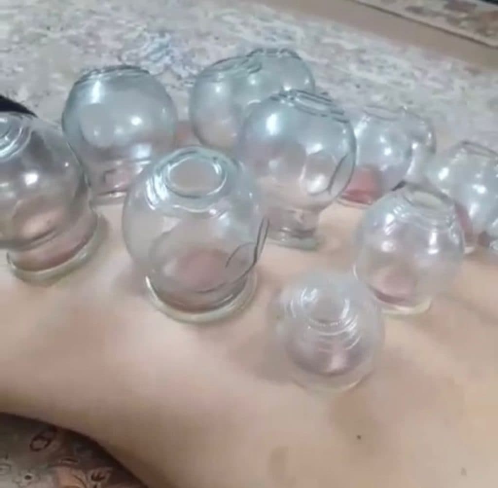 مهسا حلاجی حکیم طب سنتی و حجامت بادکش گرم در یزد