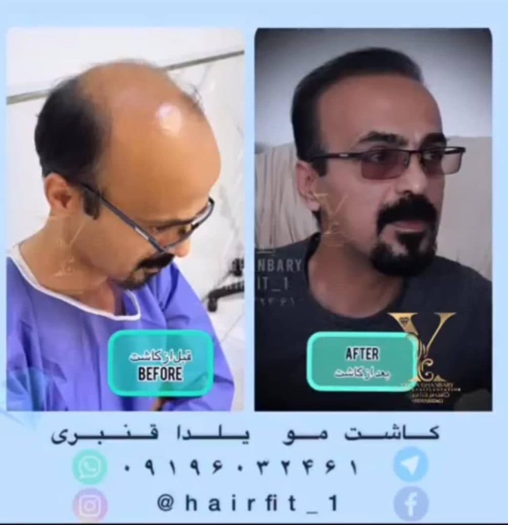 کاشت مو و ابرو و ریش یلدا قنبری در سعادت آباد تهران