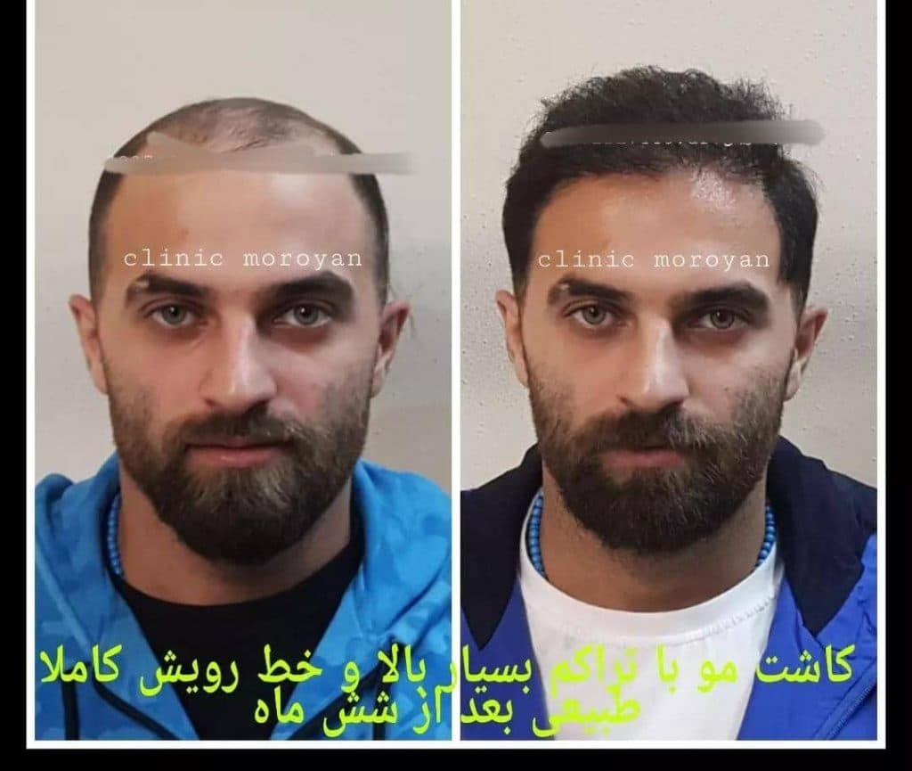 کلینیک فوق تخصصی کاشت مو و ابرو دکتر جعفریان در بابل مازندران