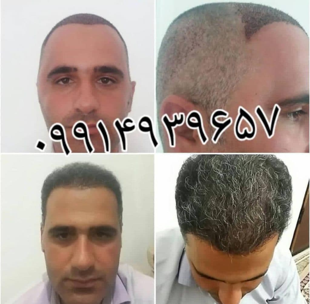 کاشت مو رشنو در کرمانشاه