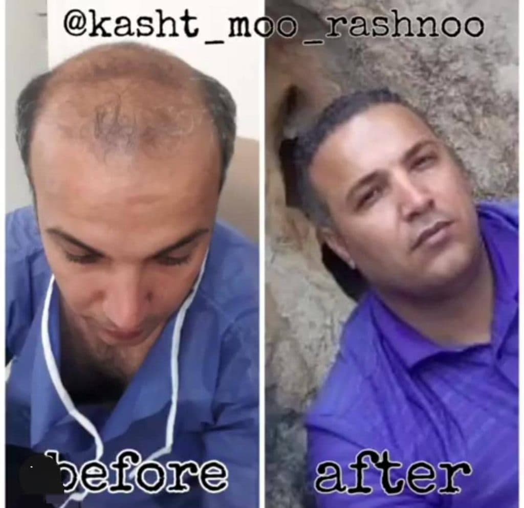 کاشت مو رشنو در کرمانشاه