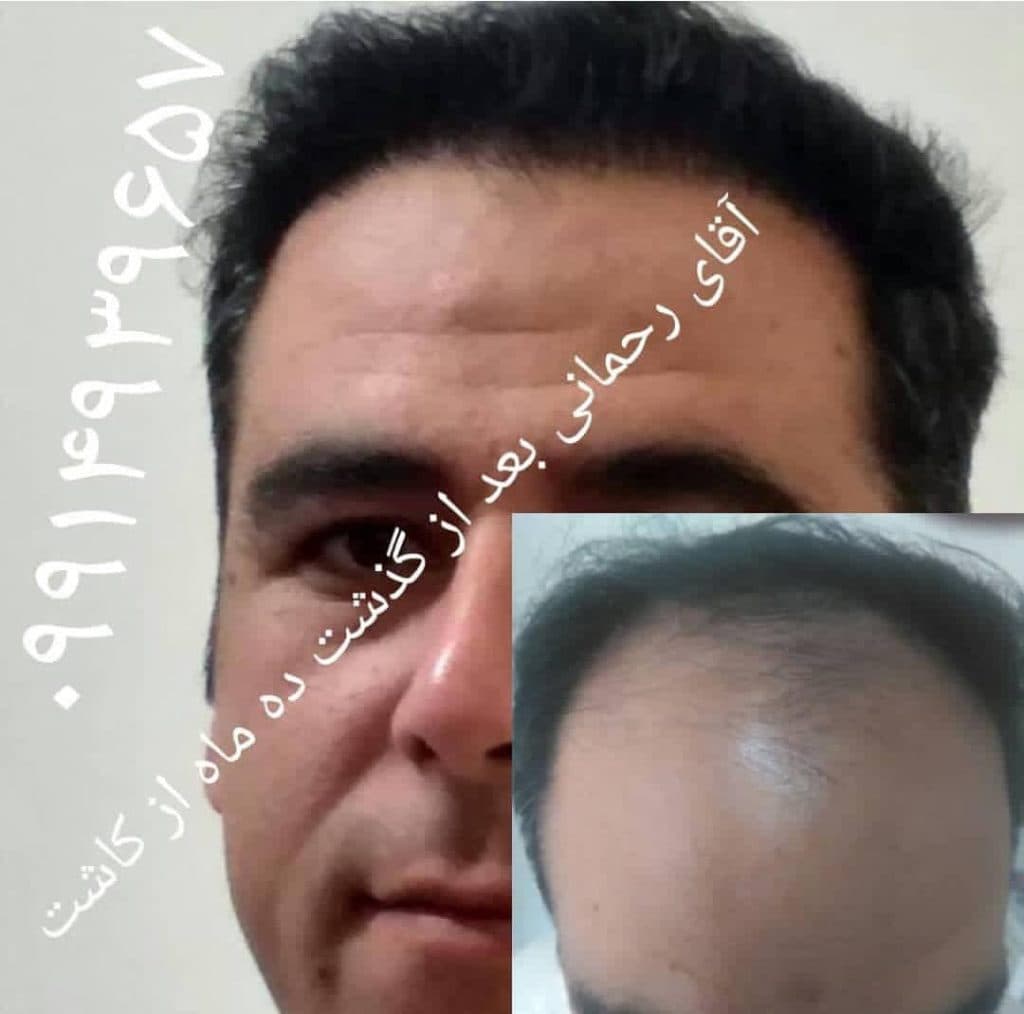 کاشت مو رشنو در کرمانشاه