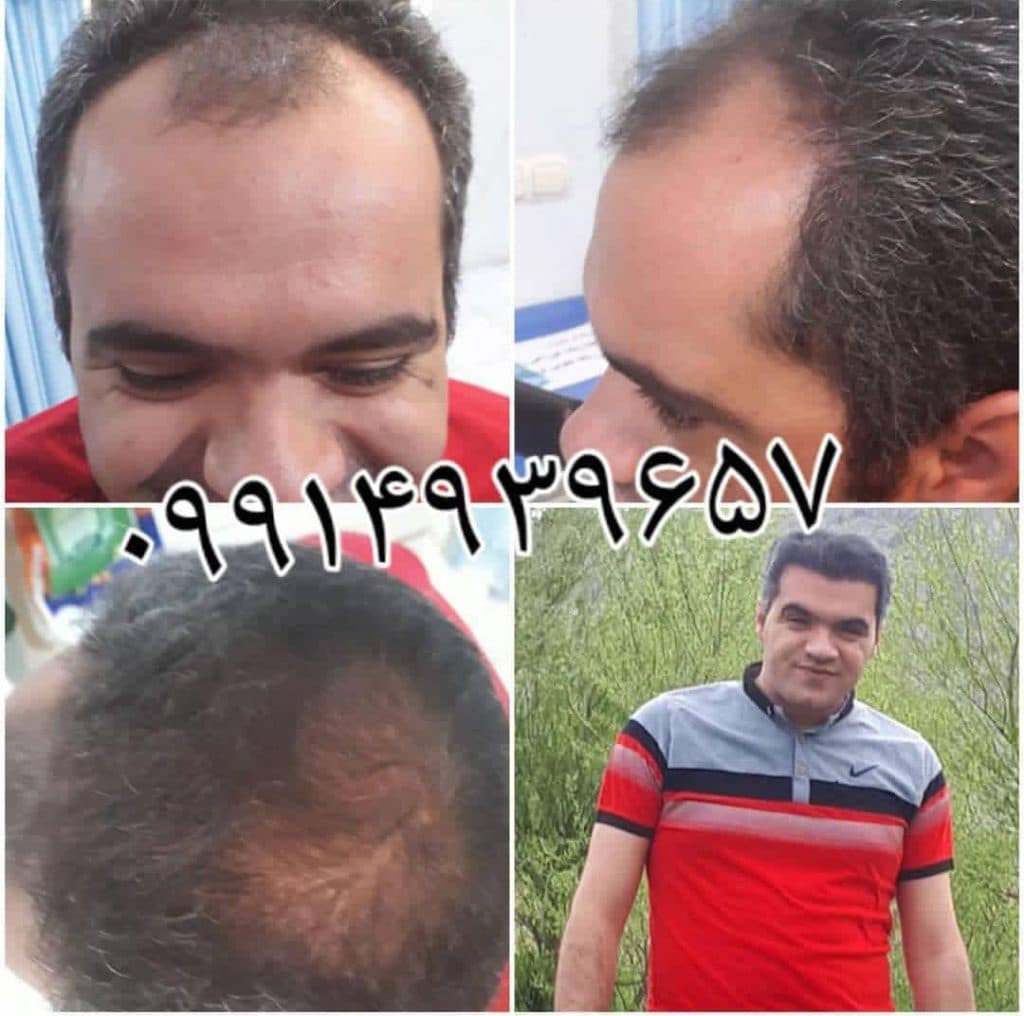 کاشت مو رشنو در کرمانشاه