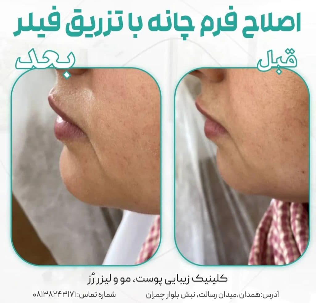 تزریق فیلر رز در همدان