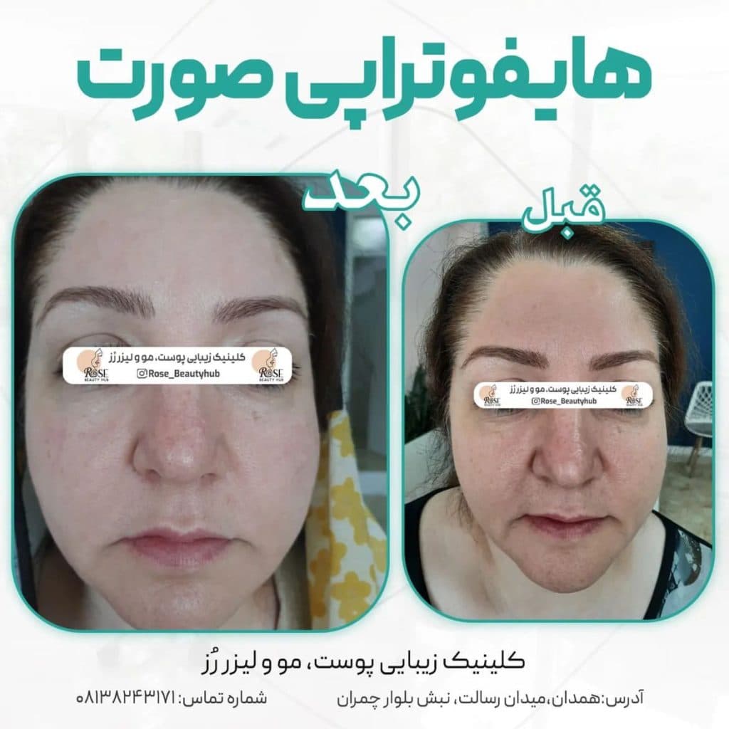 هایفوتراپی دابلوگلد پریمیوم رز در همدان