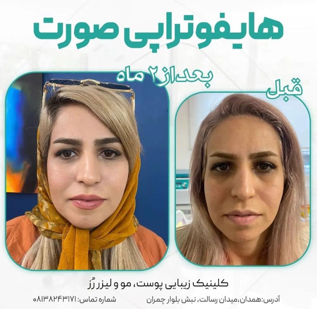 هایفوتراپی دابلوگلد پریمیوم رز در همدان