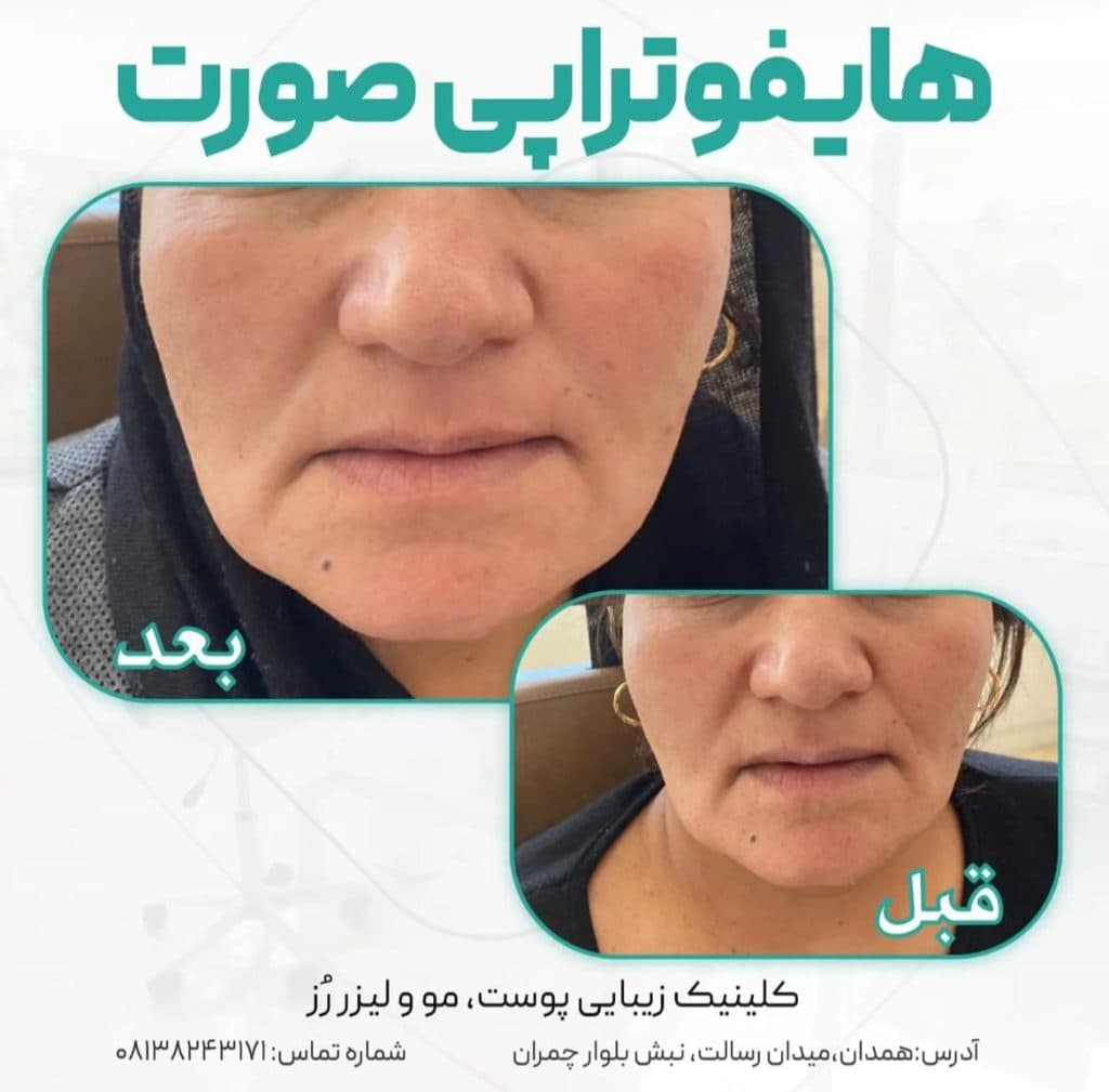 هایفوتراپی دابلوگلد پریمیوم رز در همدان