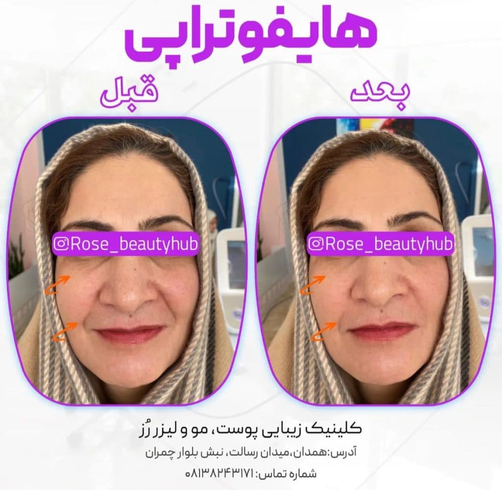 هایفوتراپی دابلوگلد پریمیوم رز در همدان