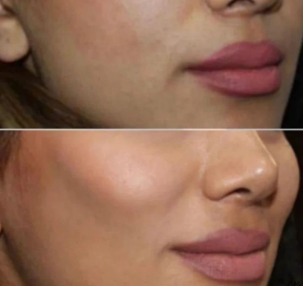 خدمات تزریق ژل و بوتاکس و فیبروز و ریموو و ابرو حسن زاده در بندرعباس