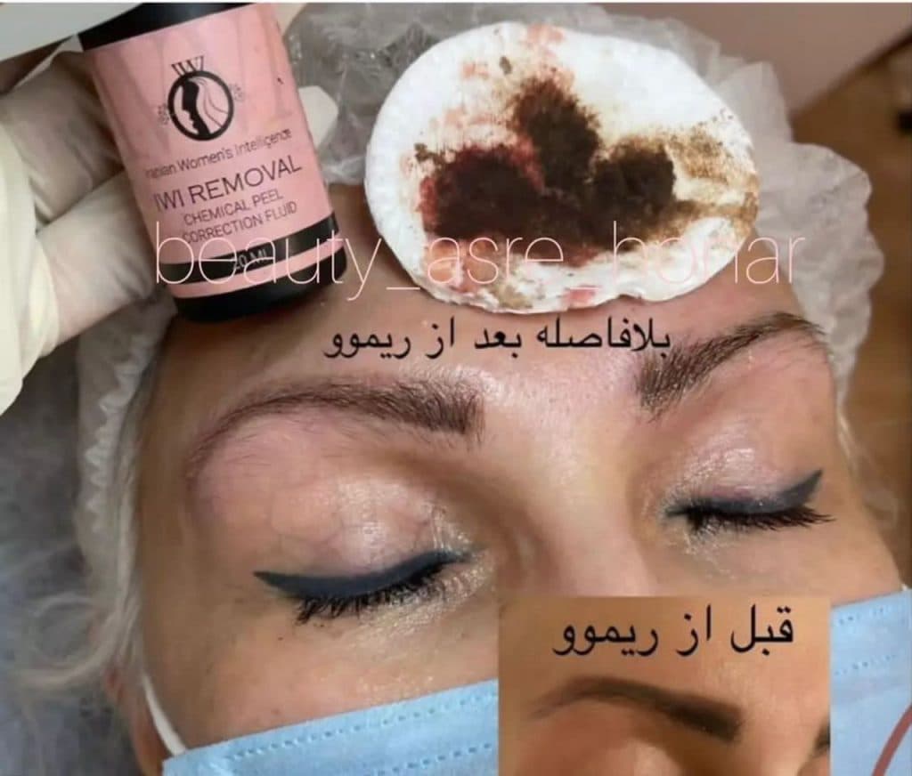 خدمات تزریق ژل و بوتاکس و فیبروز و ریموو و ابرو حسن زاده در بندرعباس