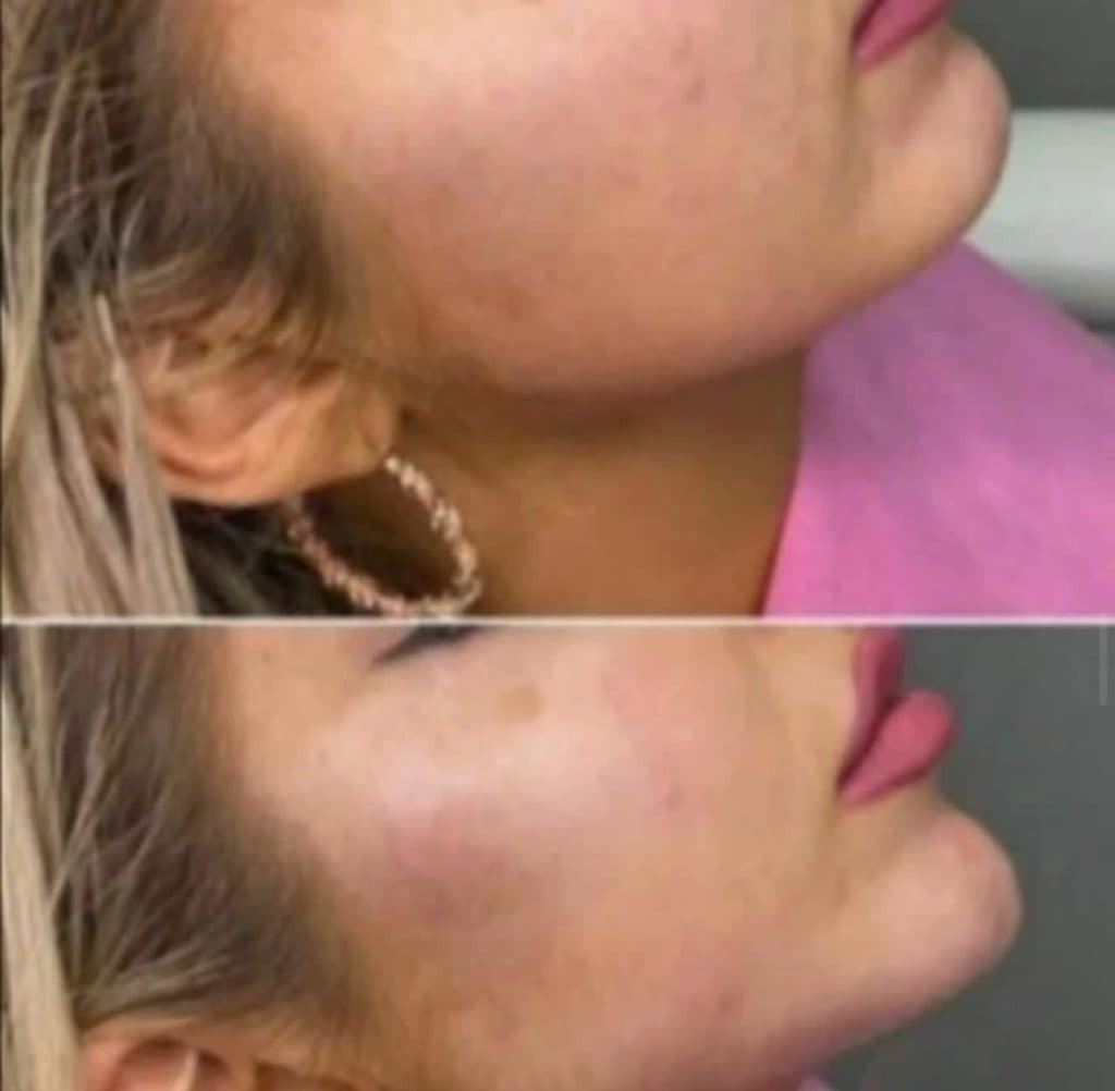 خدمات تزریق ژل و بوتاکس و فیبروز و ریموو و ابرو حسن زاده در بندرعباس