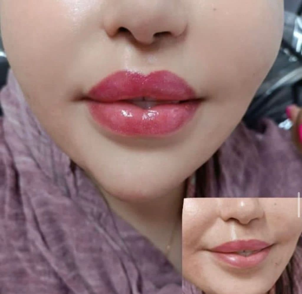 خدمات تزریق ژل و بوتاکس و فیبروز و ریموو و ابرو حسن زاده در بندرعباس