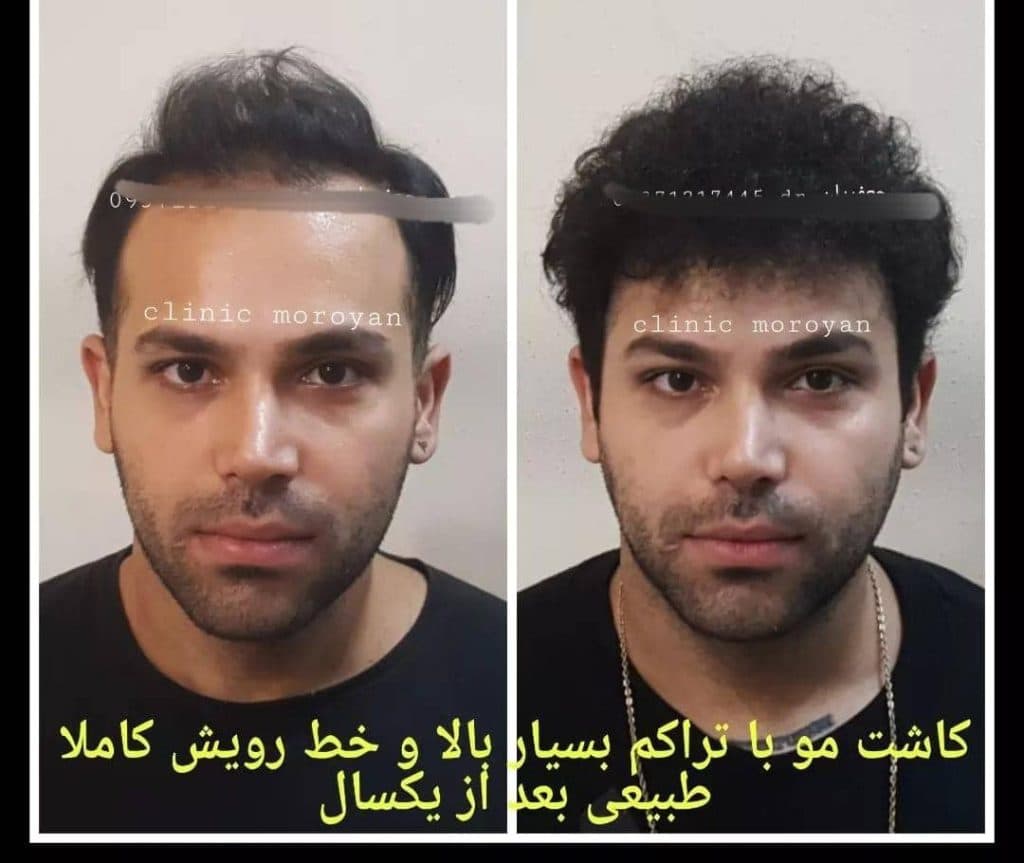 کلینیک فوق تخصصی کاشت مو و ابرو دکتر جعفریان در بابل مازندران
