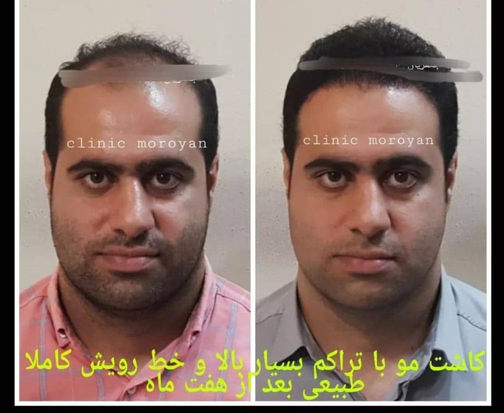 کلینیک فوق تخصصی کاشت مو و ابرو دکتر جعفریان در بابل مازندران
