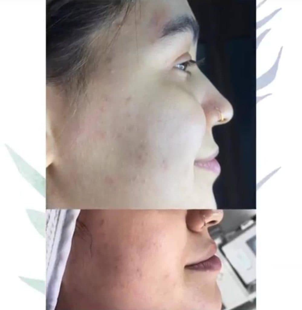 خدمات تخصصی فشیال پوست ماه در رحمت آباد شیراز