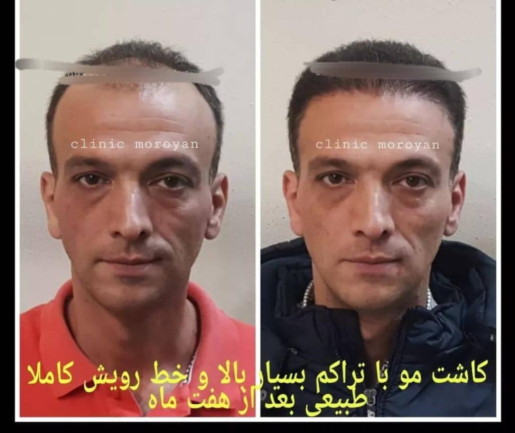 کلینیک فوق تخصصی کاشت مو و ابرو دکتر جعفریان در بابل مازندران