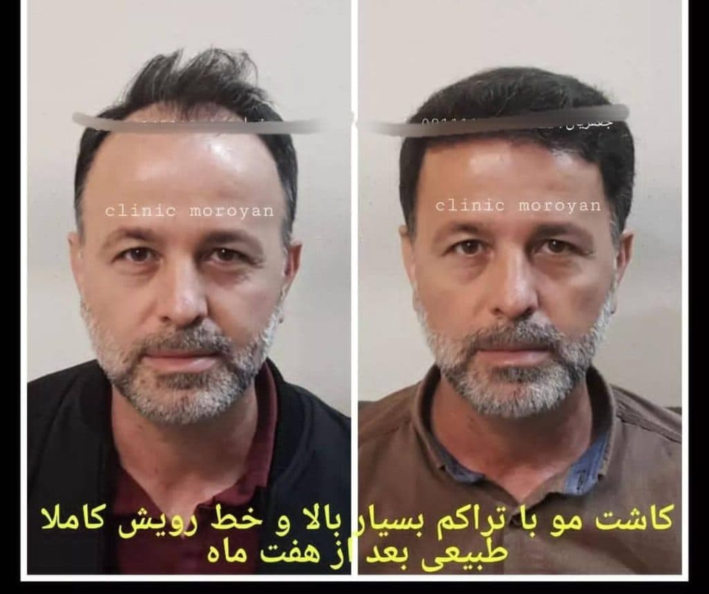 کلینیک فوق تخصصی کاشت مو و ابرو دکتر جعفریان در بابل مازندران