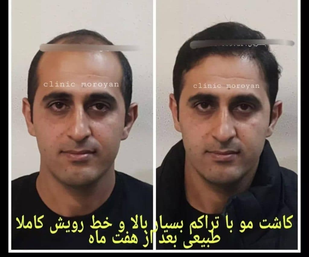کلینیک فوق تخصصی کاشت مو و ابرو دکتر جعفریان در بابل مازندران