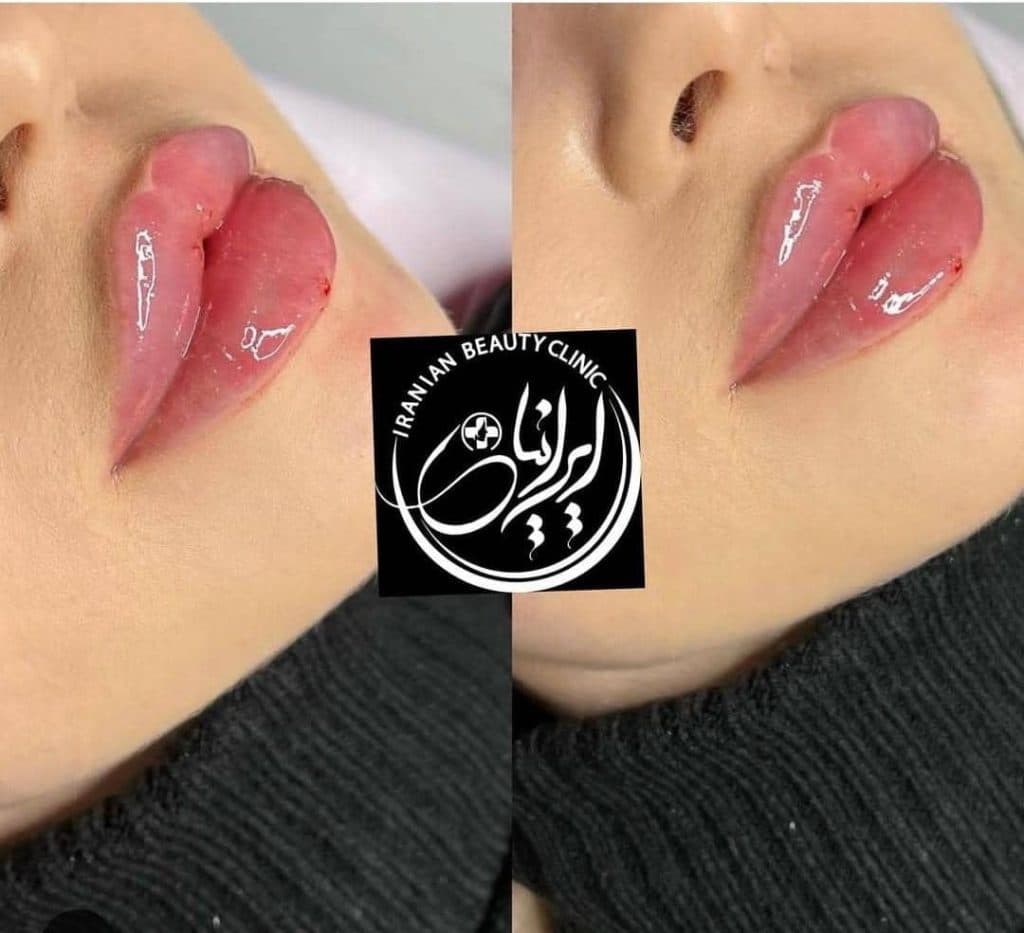 تزریق ژل و بوتاکس دکتر مهسا فتحی در ارومیه