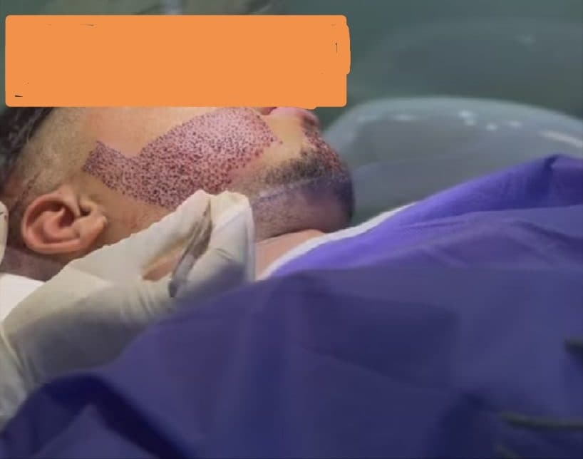 خدمات کاشت مو ریش ابرو الماس زیبایی در مشهد