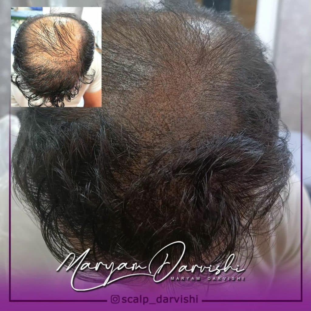 میکرواسکالپ پارسیان در اهواز