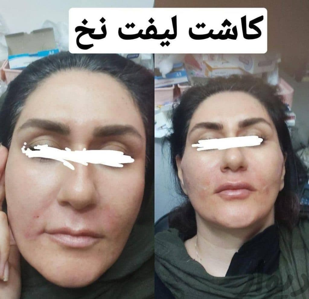 مطب زیبایی میری در تبریز