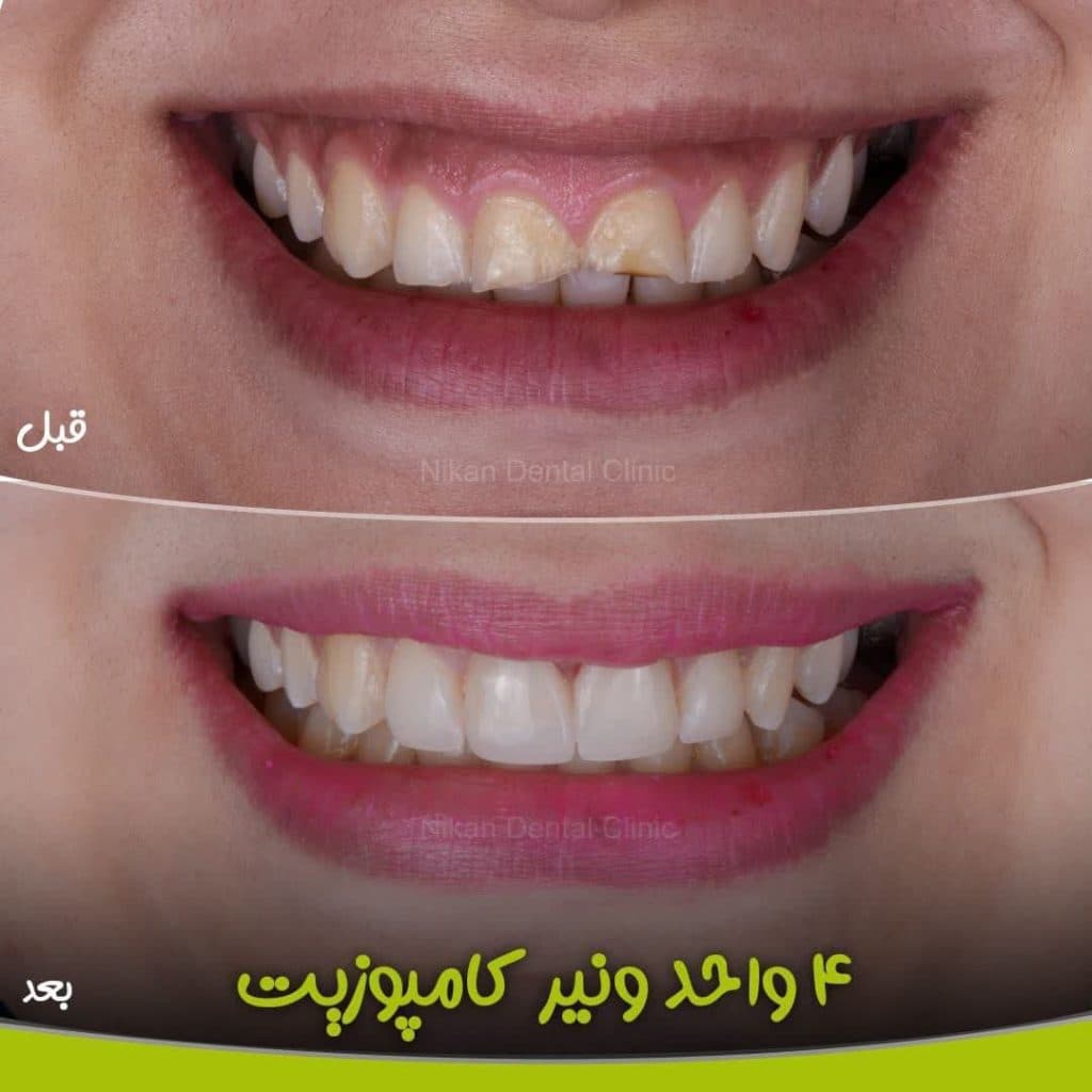 کلینیک ایمپلنت عصب کشی ارتودنسی کامپوزیت دندانپزشکی نیکان در اهواز