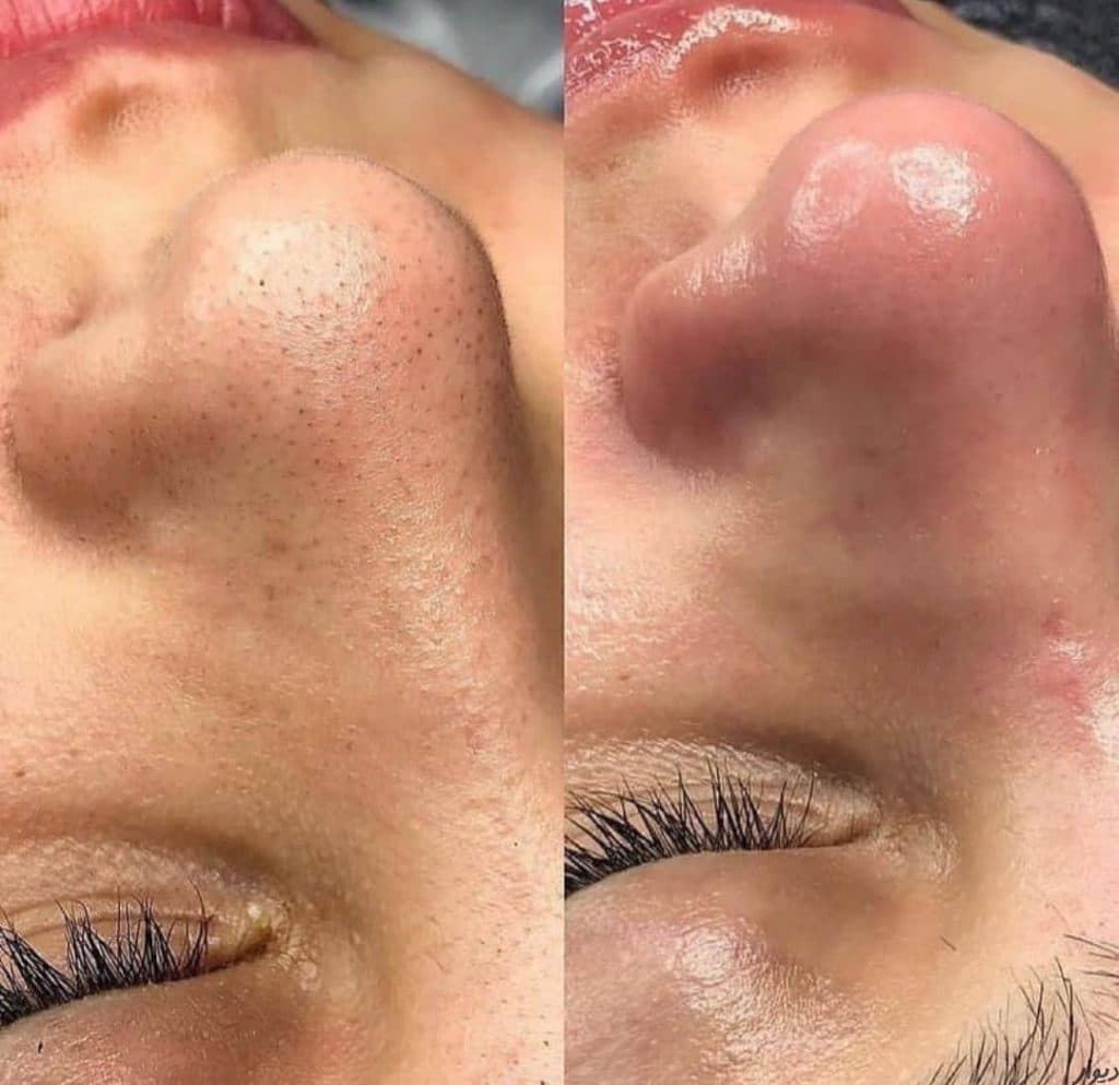 آموزش و خدمات تخصصی فشیال و درمان پوست مریم مینایی در تبریز