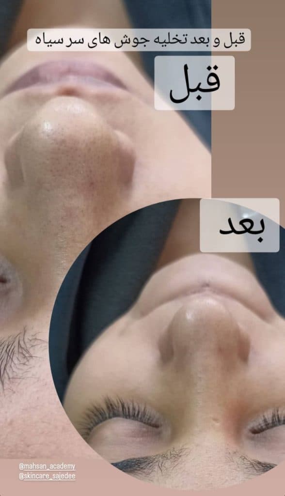 آموزش و خدمات فشیال تخصصی و پاکسازی پوست ساجده افضلی در مشهد