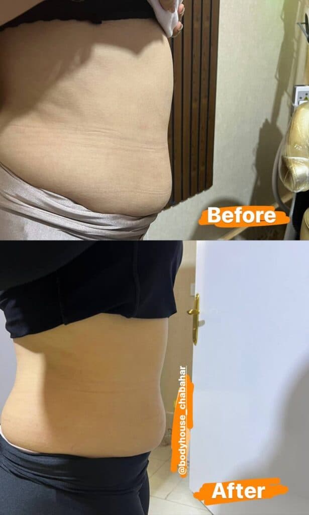 کلینیک تخصصی لاغری و پیکر تراشی body house در چابهار