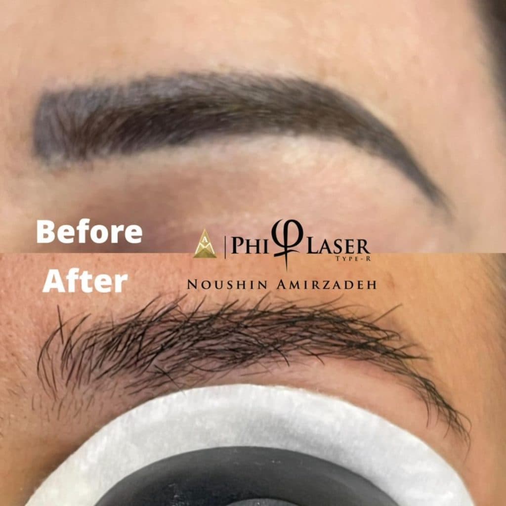 ریموو تاتو با لیزر آکادمی امیرزاده در اصفهان