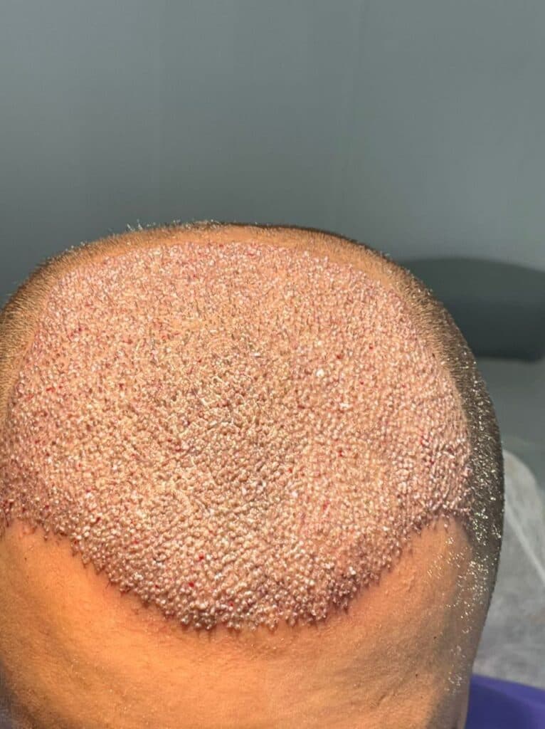 کاشت مو و ابرو دکتر مژگان کشاورز در شیراز