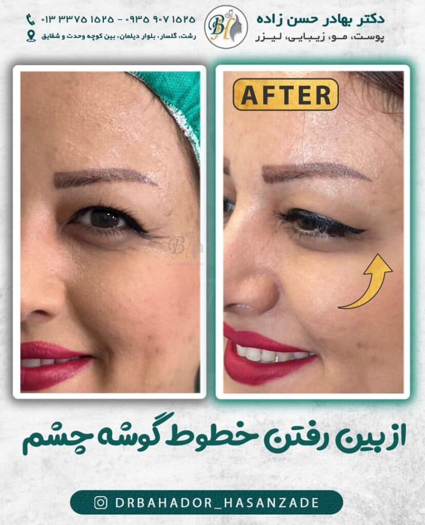 خدمات تزریق بوتاکس ژل کلینیک پوست مو زیبایی دکتر بهادر حسن زاده گلسار رشت