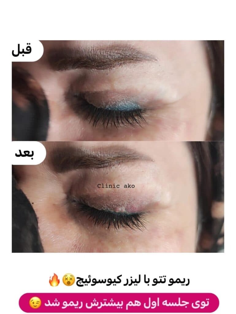 آموزش و خدمات تخصصی لیزر مزوتراپی ژل و بوتاکس آکو در اندیمشک خوزستان