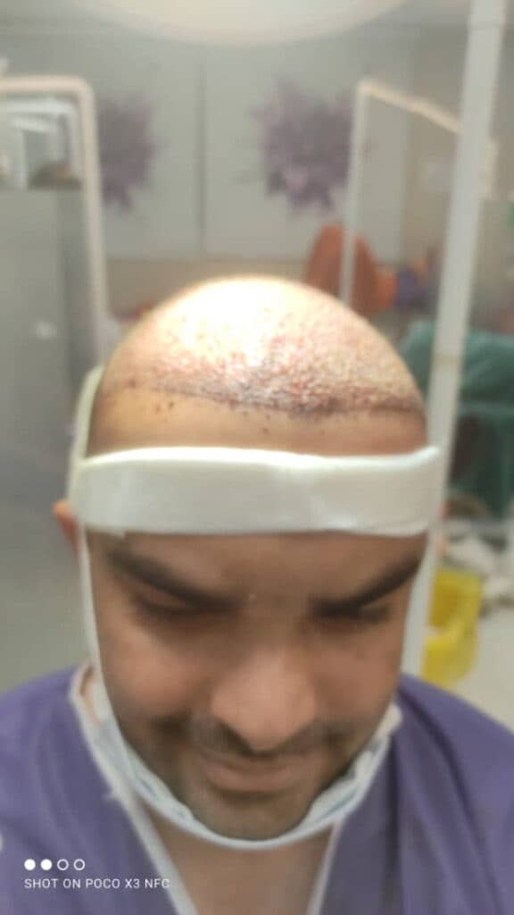 کاشت مو و ابرو دکتر مژگان کشاورز در شیراز