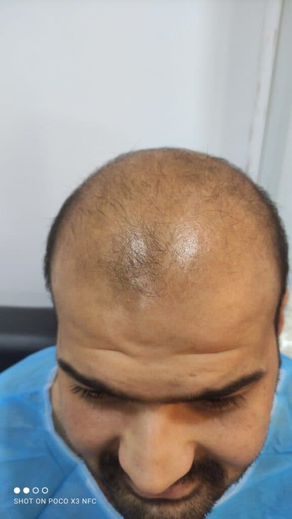 کاشت مو و ابرو دکتر مژگان کشاورز در شیراز