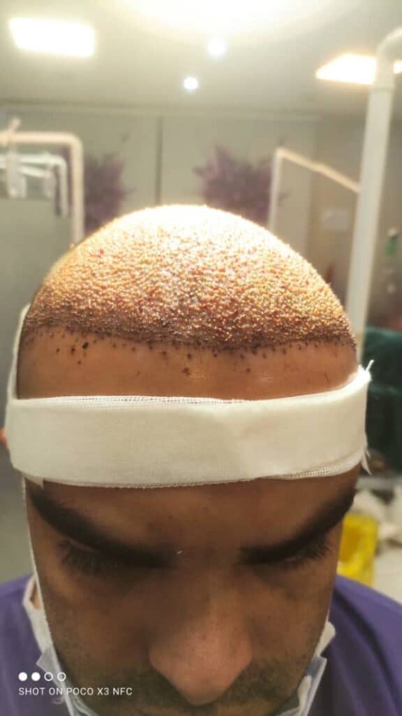 کاشت مو و ابرو دکتر مژگان کشاورز در شیراز