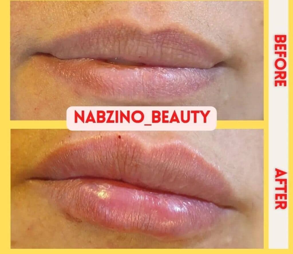 کلینیک تخصصی زیبایی لیفت نخ و طب سوزنی نبضی نو در تهران